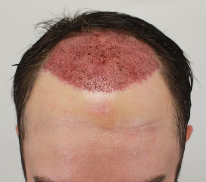 2 months post op with photos rahal hair transplant image christmas tree shop wilmington nc