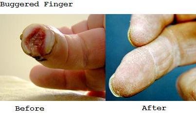 loss of fingers