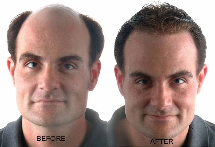 Male Pattern Baldness 