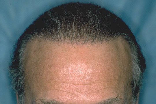 Saw Palmetto Extract For Hair Loss Related Articles