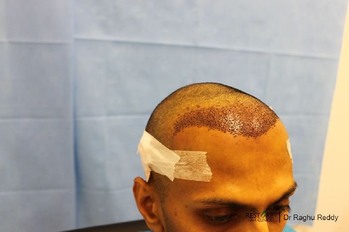 Frontal Hair Loss Propecia Php