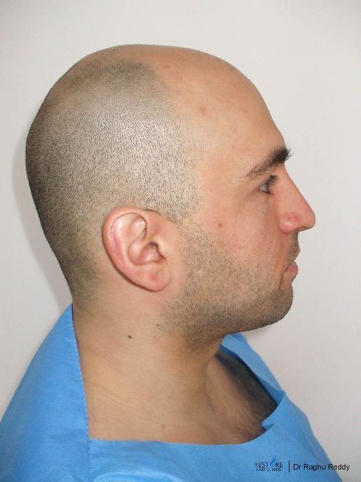 Hairloss Propecia Research