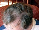 Hairmax Lasercomb