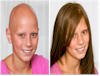 children hair loss