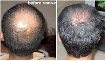 hair growth