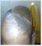 hair transplant repair