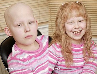 children hair loss