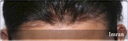 hair system