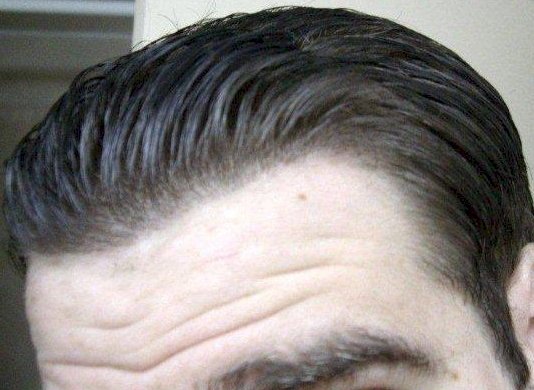 dr alvi armani hairlines
