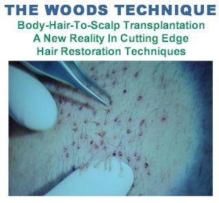 Body Hair Transplant