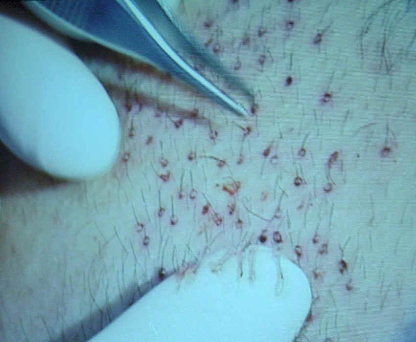 body hair transplant