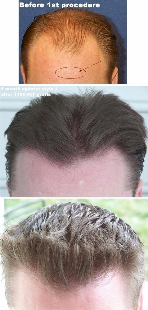 london hair transplant