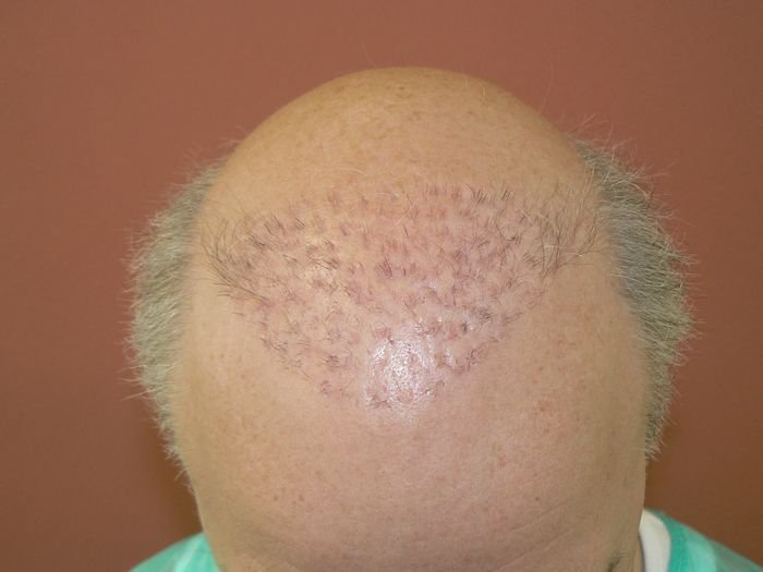 Hair Loss Forum - Dr Bisanga Plug Graft Removal HT Reversal