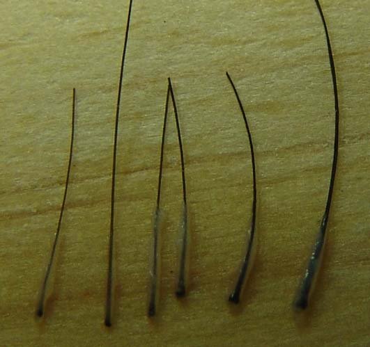 Hair Loss Forum Hair Loss Forum