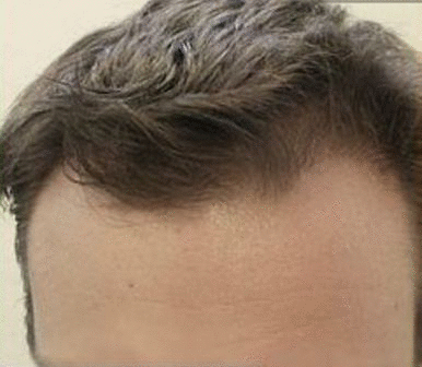 Hair Loss Forum -