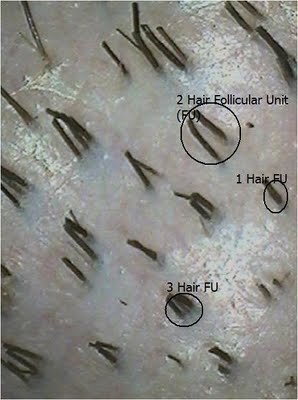 Hair Loss Forum Dense Packing With Plucked Hair Hair Loss Forum Dense Packing With Plucked Hair