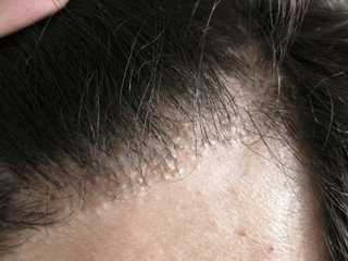 Hair Loss Forum Left Side Lag