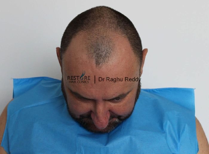 Dr Raghu Reddy FUE hair transplant on a man with with Norwood 4 ...