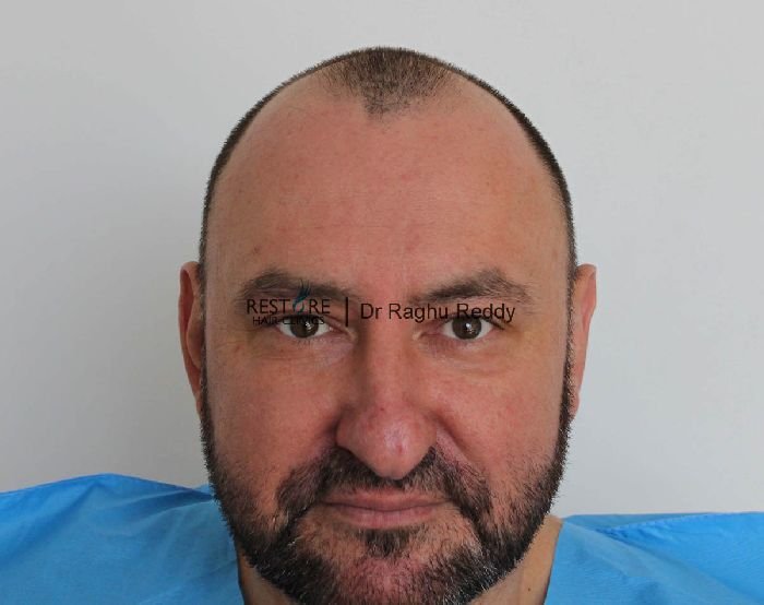 Dr Raghu Reddy FUE hair transplant on a man with with Norwood 4 ...