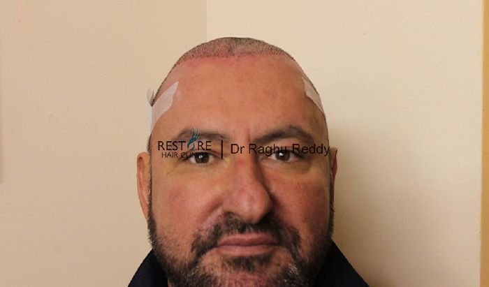 Dr Raghu Reddy FUE hair transplant on a man with with Norwood 4 ...