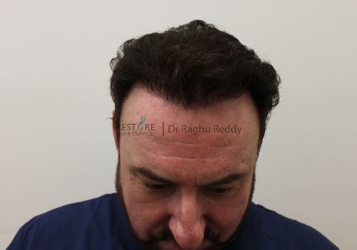 Dr Raghu Reddy FUE hair transplant on a man with with Norwood 4 ...