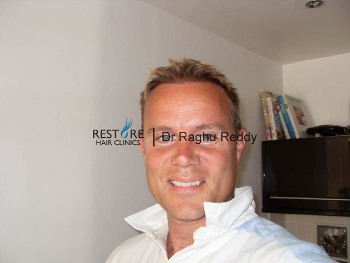 Dr Reddy FUE results on Gladiator ACE - Norwood 4, 979 grafts - Results ...