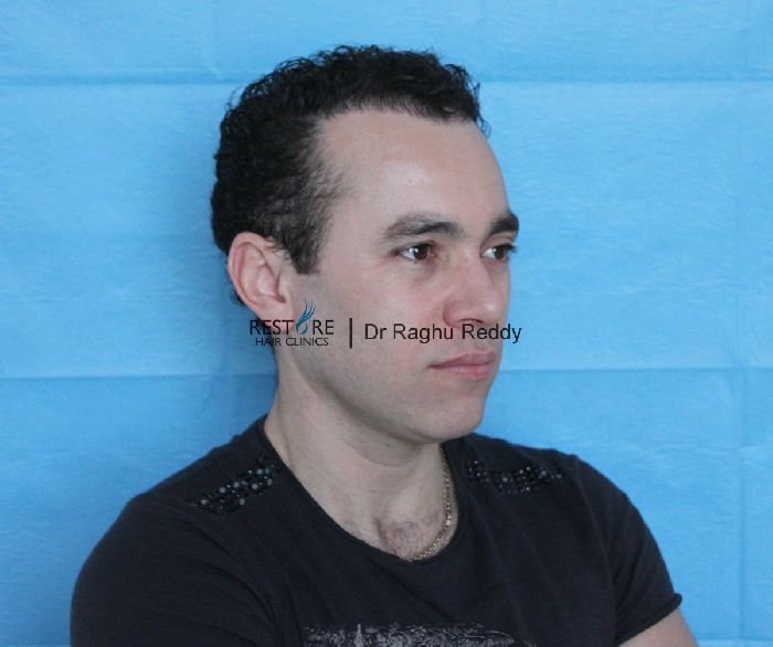Dr Reddy FUE hair transplant - Norwood 4, 1083 grafts - Results Posted ...