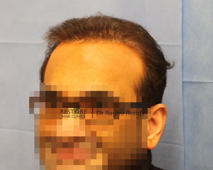 FUE by Dr Reddy - correction work, 2718 grafts, Norwood 7 - Results ...