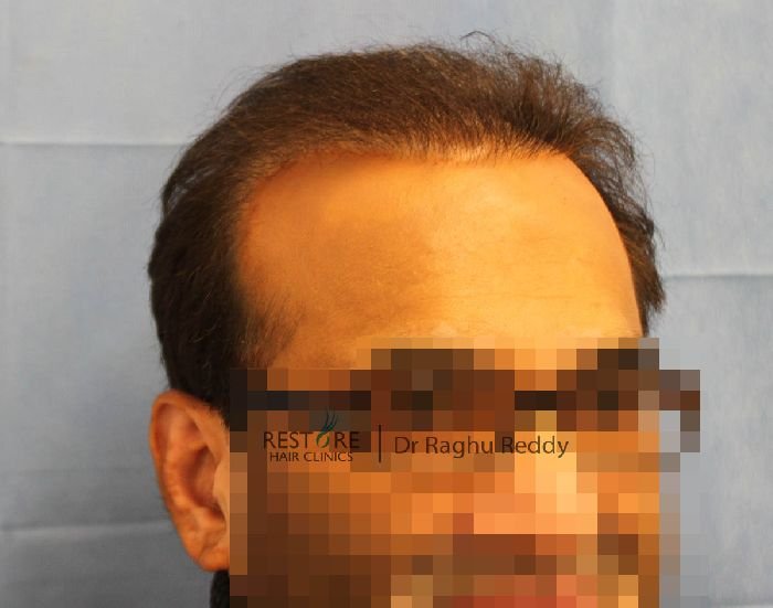 FUE by Dr Reddy - correction work, 2718 grafts, Norwood 7 - Results ...